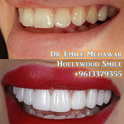 direct veneers