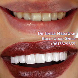direct veneers