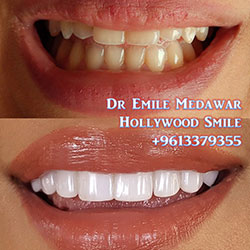direct veneers