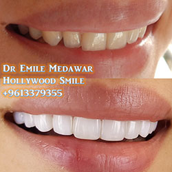 direct veneers