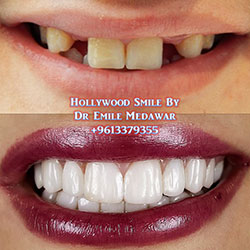 the best dental implants in Lebanon beirut