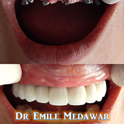 dental implantsin Lebanon beirut