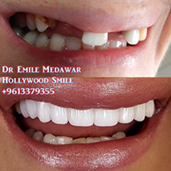 direct veneers