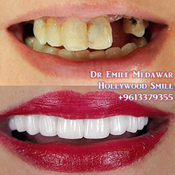 dental implants lebanon