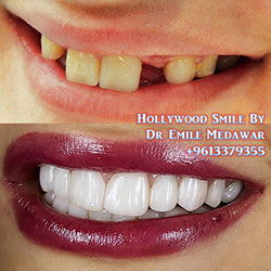 dental implants lebanon beirut