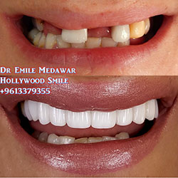 best dental implants in lebanon