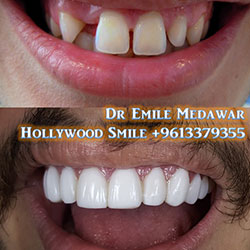 dental implants beirut lebanon