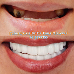 dental implants price in BeirutLebanon