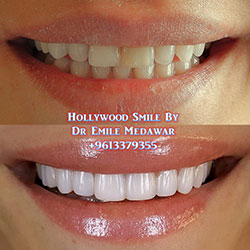 Direct Veneers