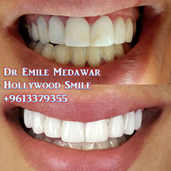 direct veneers