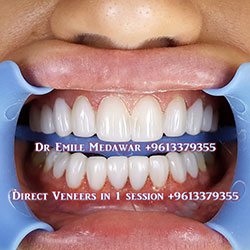 direct veneers