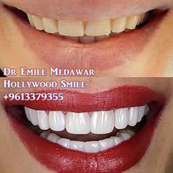direct veneers