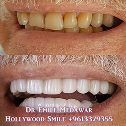 direct veneers