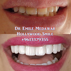 direct veneers
