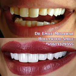 direct veneers