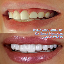 direct veneers