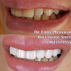direct veneers