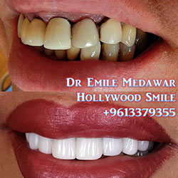 direct veneers