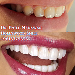 direct veneers