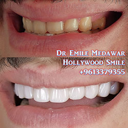 direct veneers