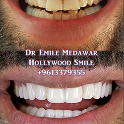 direct veneers