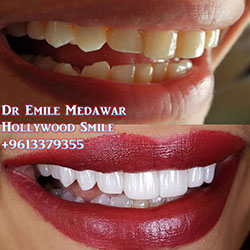 direct veneers