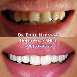 direct veneers