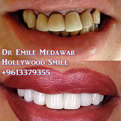 direct veneers