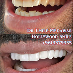 direct veneers