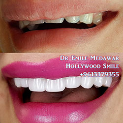 direct veneers