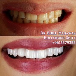 direct veneers