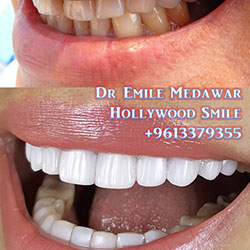direct veneers