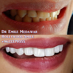 direct veneers
