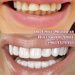 direct veneers