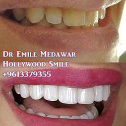 direct veneers