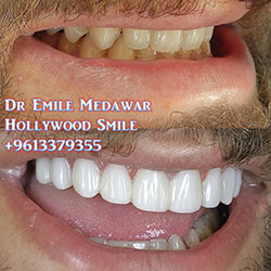 direct veneers