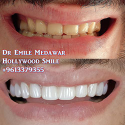 direct veneers