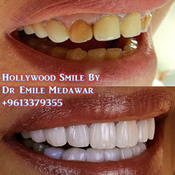 Emax Veneers Lebanon