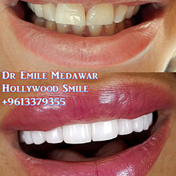 direct veneers