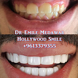 direct veneers