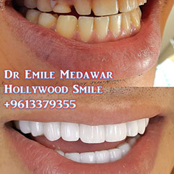 direct veneers