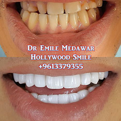 direct veneers