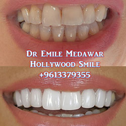 direct veneers