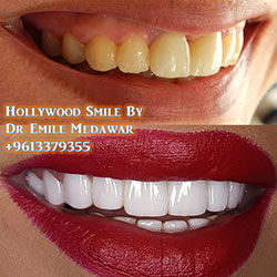 direct veneers