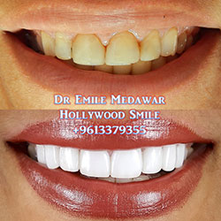 direct veneers