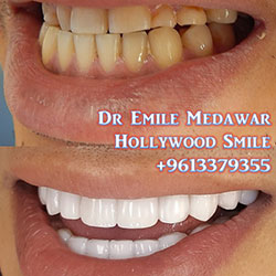 direct veneers