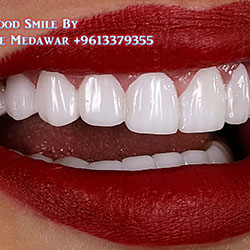 Hollywood Smile Lebanon