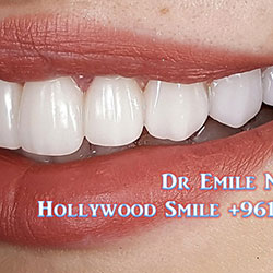 direct veneers