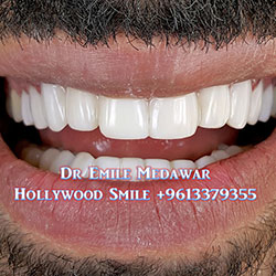 direct veneers