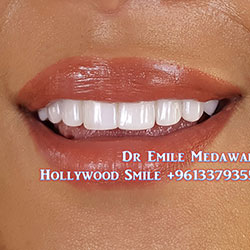 direct veneers